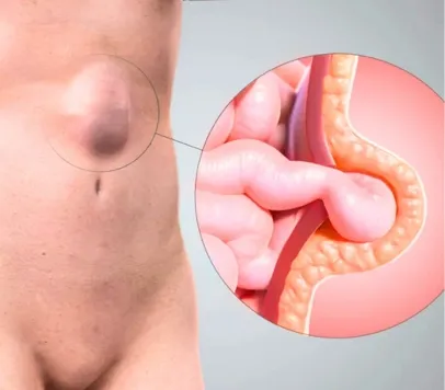 What is a hernia?